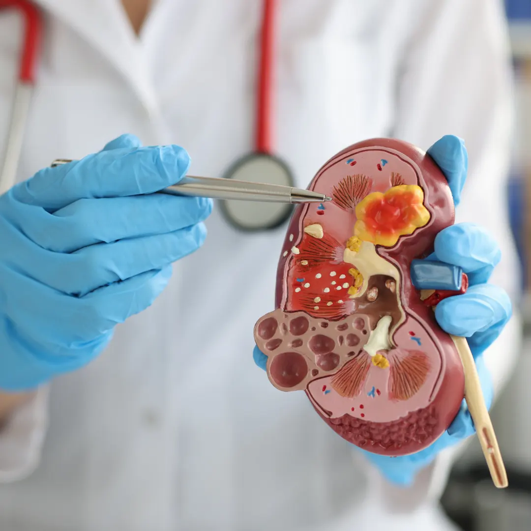 Cirurgia a laser para cálculos renais — procedimento moderno e minimamente invasivo